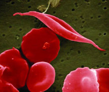 Sickle cell disease