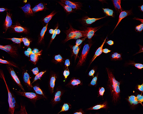 Microscopy image shows glioma tumor cells in blue and pink.