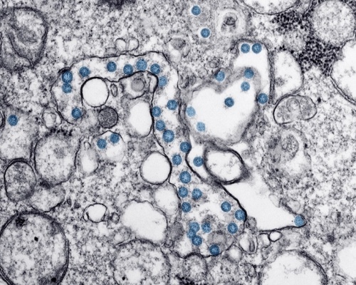 SARS-CoV-2 viral particles (blue) in a clinical isolate. (Credit: <a href=detailsc7af-2.html target="_blank">CDC</a>)