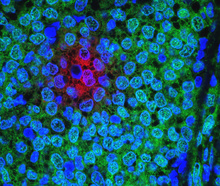 Breast cancer cells. (Credit: <a href=details11c3.html target="_blank">NCI</a>)