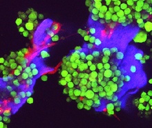 A fluorescent microscopy image showing multiple myeloma cells colored green and bone cells colored red, growing on an artificial scaffold colored purple,