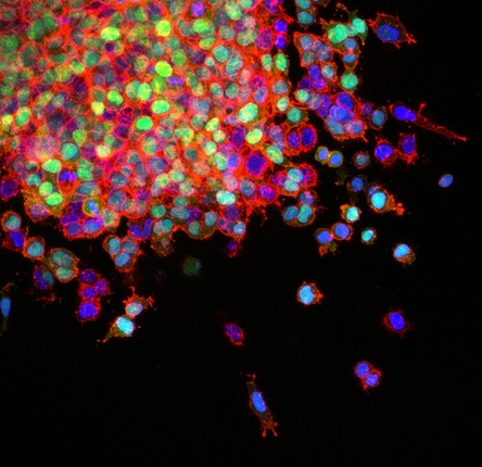 Microscopy image of lung cancer cells shown in bright colors (blue and green)