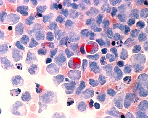 Human cells with acute myelocytic leukemia (AML) in the pericardial fluid.