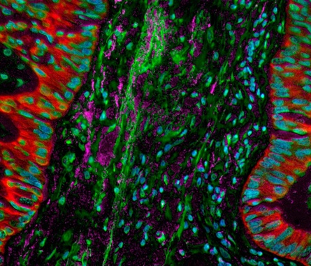 Cancer cells
