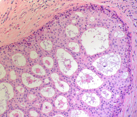 A histopathology image of ductal carcinoma in situ (DCIS) of the breast. The image shows a section of breast tissue stained with hematoxylin and eosin, revealing clusters of abnormal cells within the milk ducts. The ducts are filled with atypical cells exhibiting a cribriform pattern, characterized by round to oval spaces within the neoplastic cell clusters. The surrounding tissue appears dense and fibrous.