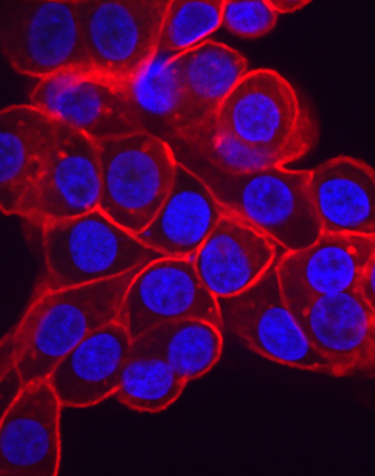 Ovarian cancer cells overexpress high levels of the phosphate importer protein SLC34A2 (red) which pumps phosphate into a cell and leaves it vulnerable to inhibiting phosphate export. Cell nuclei are shown in blue.