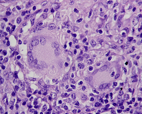 A histological slide showing tissue from an intenstinal lymph node in a patient with Crohn's disease.